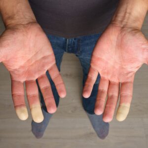 Fenomeno di Raynaud - reumatologo - Poliambulatorio Sinergo