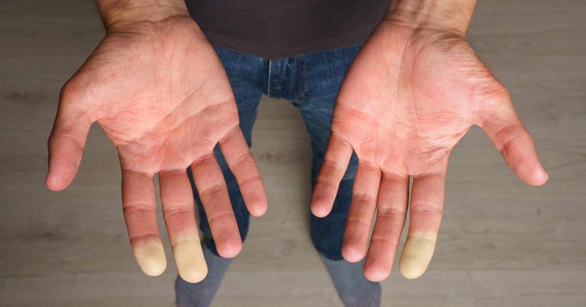 Fenome di Raynaud Poliambulatorio Sinergo - Reumatologia